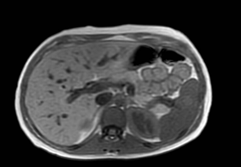 File:Appendicitis in gravida (MRI) (Radiopaedia 89433-106395 Axial T1 in-phase 14).jpg
