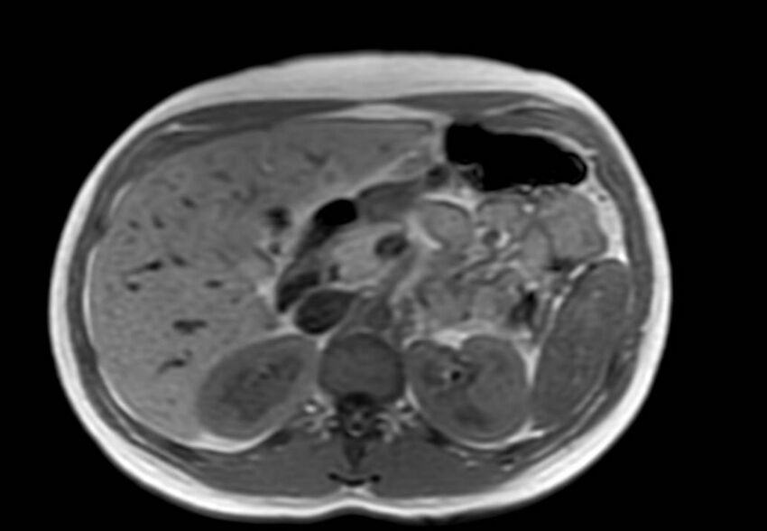 Appendicitis in gravida (MRI) (Radiopaedia 89433-106395 Axial T1 in-phase 18).jpg