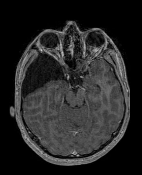 File:Arachnoid cyst- extremely large (Radiopaedia 68741-78451 Axial T1 C+ 31).jpg