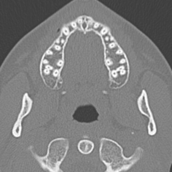 File:Arrested pneumatization of the sphenoid (Radiopaedia 10700-11172 Axial non-contrast 24).jpg