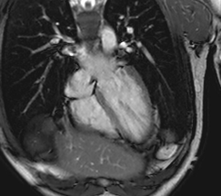 Arrhythmogenic right ventricular cardiomyopathy (Radiopaedia 39806-42237 D 140).jpg