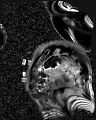 Arrhythmogenic right ventricular cardiomyopathy (Radiopaedia 57972-64966 D 14).jpg