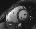 Arrhythmogenic right ventricular cardiomyopathy (Radiopaedia 69564-79464 short axis cine 180).jpg
