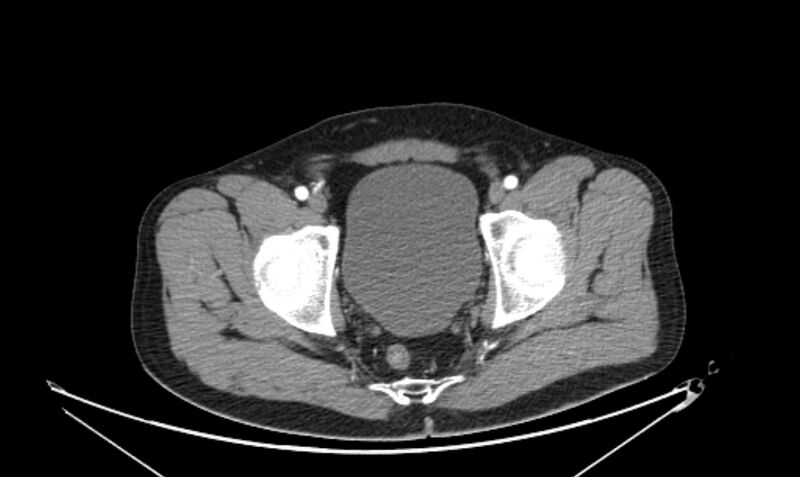 File:Arterial occlusive mesenteric ischemia (Radiopaedia 84641-100060 A 120).jpg