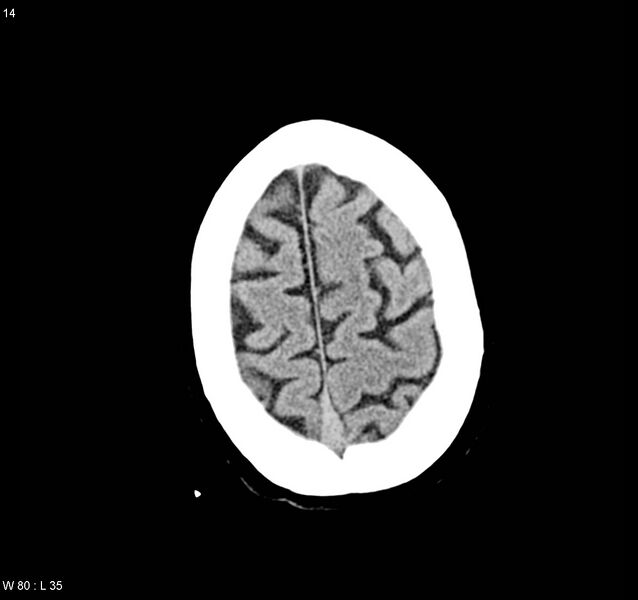 File:Arteriovenous malformation - cerebral (Radiopaedia 8172-9020 Axial non-contrast 22).jpg