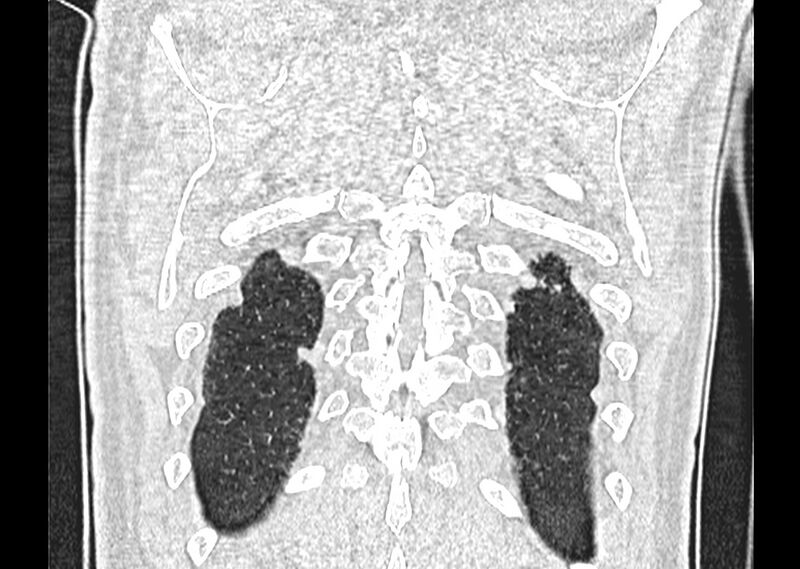 File:Asbestos pleural placques (Radiopaedia 57905-64872 Coronal lung window 268).jpg