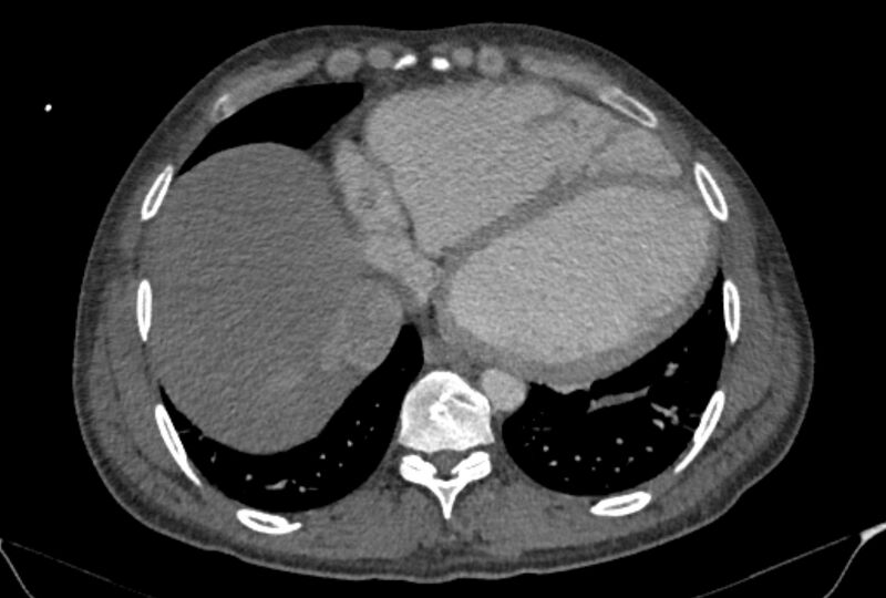 File:Ascending aortic aneurysm (Radiopaedia 86279-102297 C 51).jpg