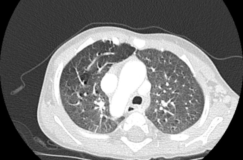 File:Asplenia syndrome (Radiopaedia 73083-83792 Axial lung window 20).jpg