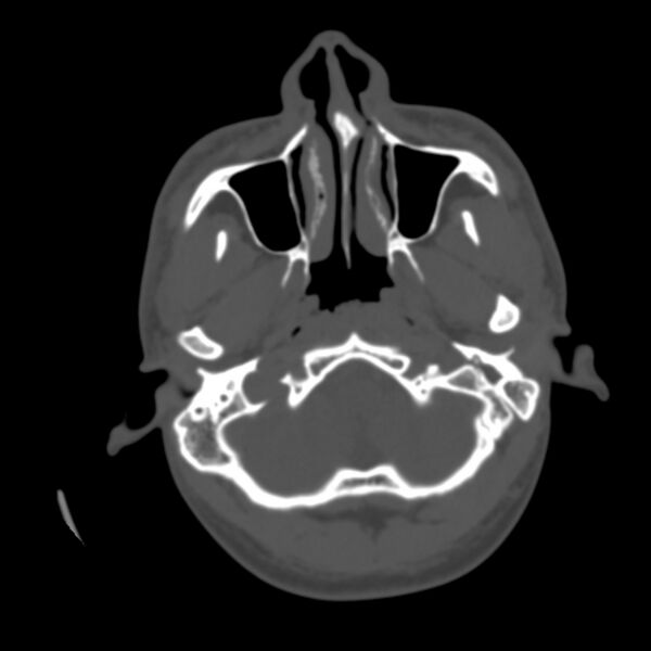 File:Asymptomatic occipital spur (Radiopaedia 87753-104201 Axial bone window 12).jpg