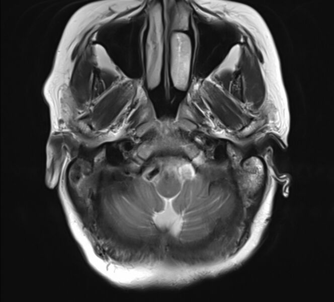 File:Atlanto-occipital assimilation with basilar invagination (Radiopaedia 70122-80157 Axial T2 3).jpg