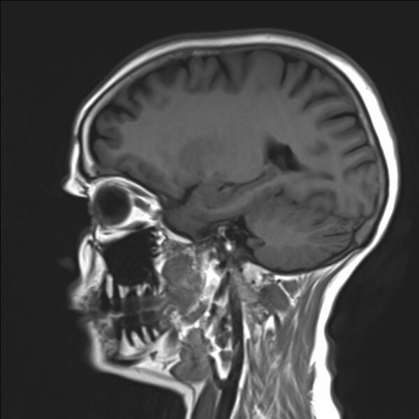 File:Atlanto-occipital assimilation with basilar invagination (Radiopaedia 70122-80157 Sagittal T1 16).jpg