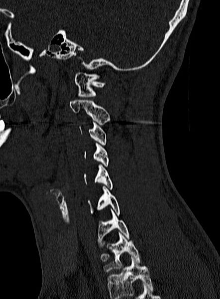 File:Atlantoaxial subluxation (Radiopaedia 44681-48450 Sagittal bone window 130).jpg