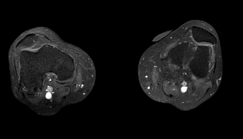 Atypical lipomatous tumor - thigh (Radiopaedia 68975-78734 Axial T1 C+ fat sat 12).jpg