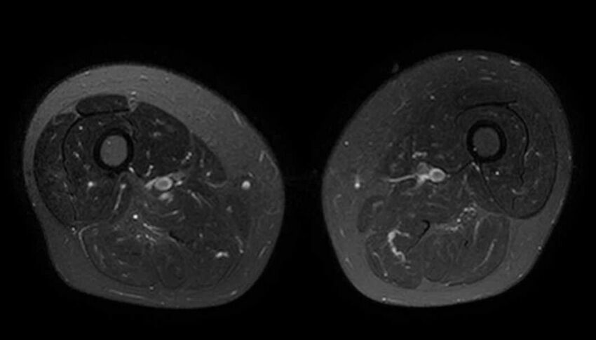 Atypical lipomatous tumor - thigh (Radiopaedia 68975-78734 Axial T2 fat sat 45).jpg