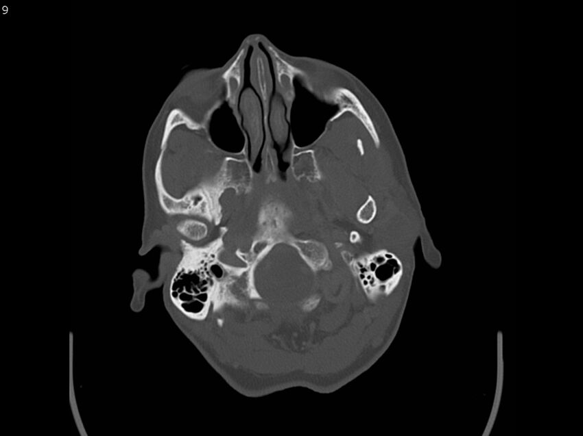 Atypical meningioma - intraosseous (Radiopaedia 64915-73867 Axial C+ bone window 9).jpg