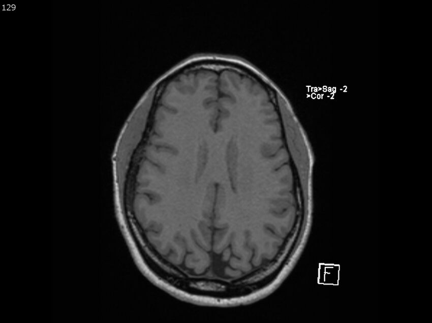 Atypical meningioma - intraosseous (Radiopaedia 64915-74572 Axial T1 129).jpg
