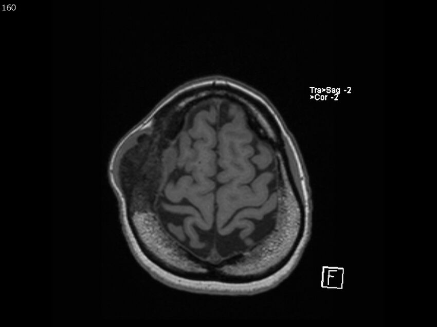 Atypical meningioma - intraosseous (Radiopaedia 64915-74572 Axial T1 160).jpg