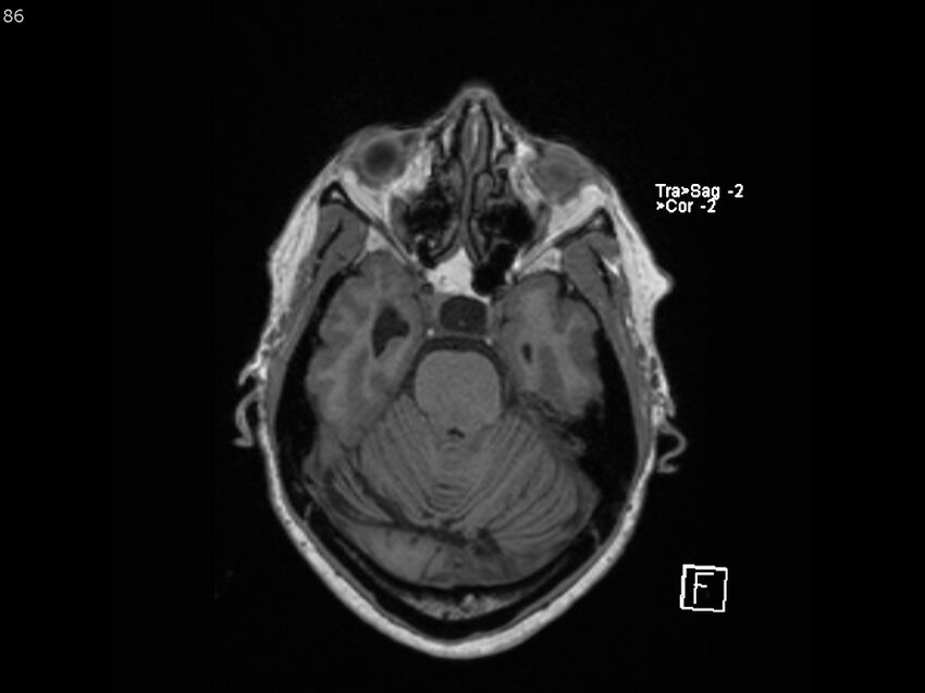 Atypical meningioma - intraosseous (Radiopaedia 64915-74572 Axial T1 86).jpg