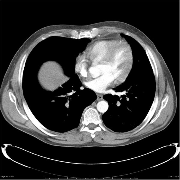File:Atypical pneumonia - Q fever (Radiopaedia 21993-21989 C+ arterial phase 30).jpg