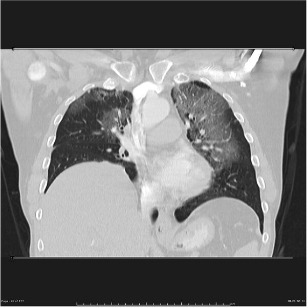 File:Atypical pneumonia - Q fever (Radiopaedia 21993-21989 C 18).jpg