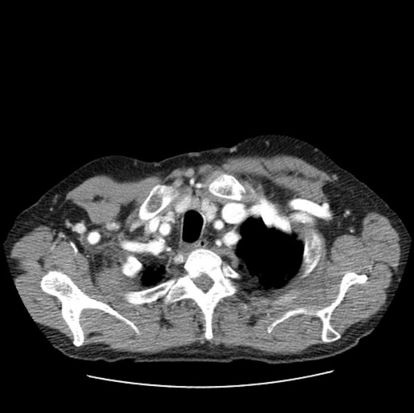 File:Autosomal dominant polycystic kidney disease (Radiopaedia 27851-28094 B 7).jpg