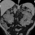 Autosomal dominant polycystic kidney disease (Radiopaedia 36539-38101 Coronal non-contrast 21).jpg
