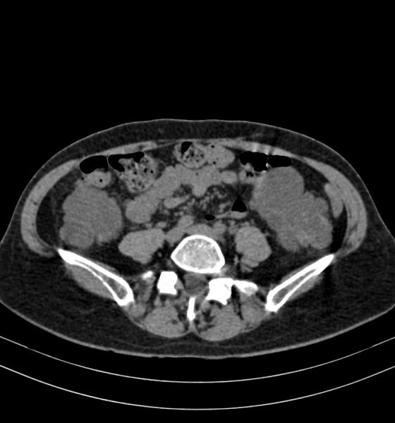 File:Autosomal dominant polycystic kidney disease (Radiopaedia 41918-44922 Axial non-contrast 22).jpg