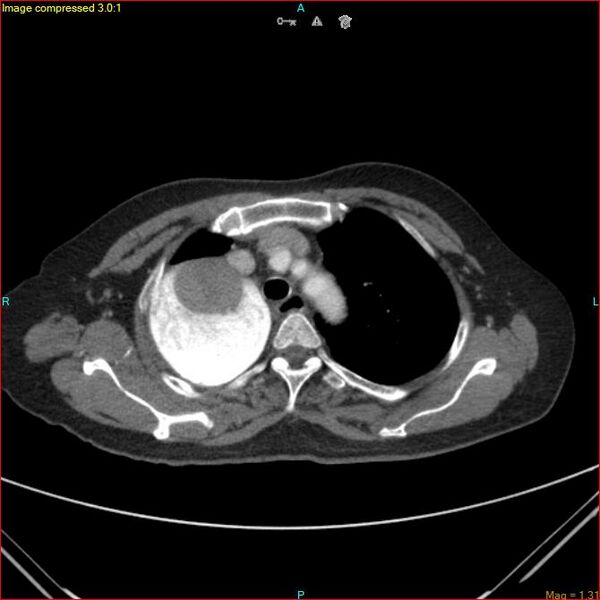 File:Azygos vein aneurysm (Radiopaedia 77824-90130 B 16).jpg