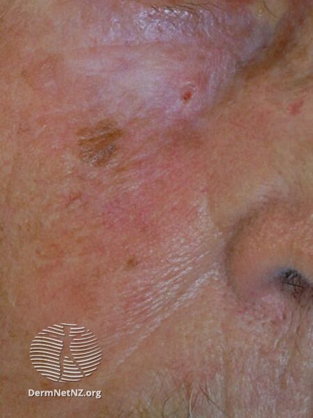 File:Basal cell carcinoma affecting the face (DermNet NZ lesions-bcc-face-0742).jpg