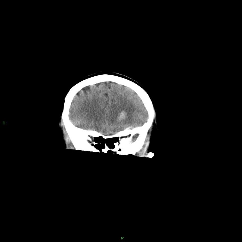 Basal ganglia hemorrhage (Radiopaedia 58349-65472 Coronal non-contrast 48).jpg