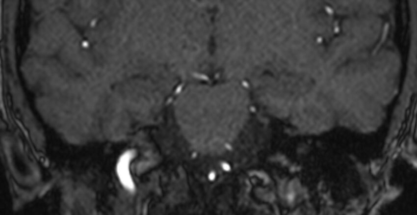 Basilar artery fenestration (Radiopaedia 74537-85455 Coronal MRA TOF 52).jpg