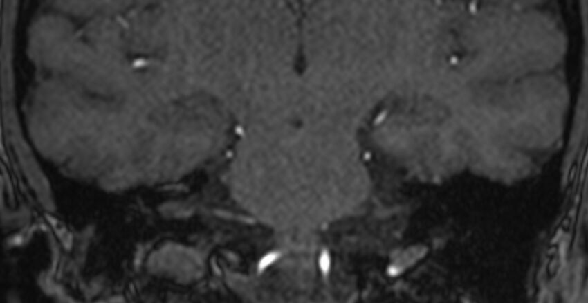 Basilar artery fenestration (Radiopaedia 74537-85455 Coronal MRA TOF 71).jpg