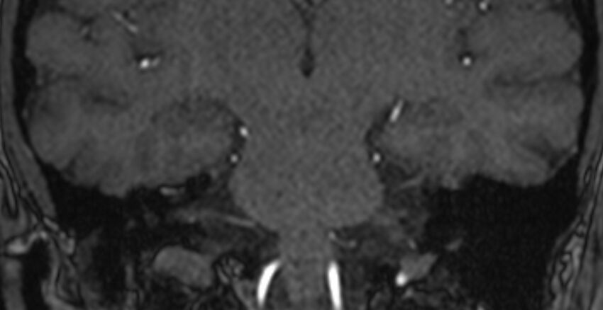 Basilar artery fenestration (Radiopaedia 74537-85455 Coronal MRA TOF 74).jpg