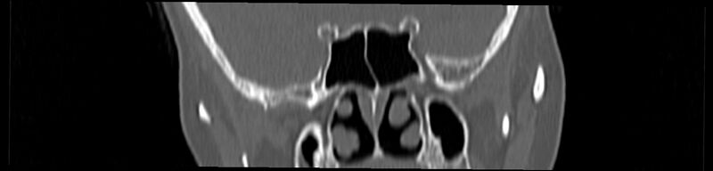 File:Basilar impression (Radiopaedia 52411-58522 Coronal bone window 2).jpg