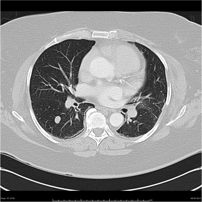 Benign metastasizing leiomyoma (Radiopaedia 26803-26962 Axial lung window 27).jpg