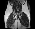 Bicornuate bicollis uterus (Radiopaedia 61626-69616 Coronal T2 30).jpg