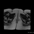 Bicornuate uterus- on MRI (Radiopaedia 49206-54297 Axial T2 20).jpg