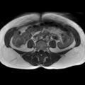 Bicornuate uterus (Radiopaedia 61974-70046 Axial T1 9).jpg