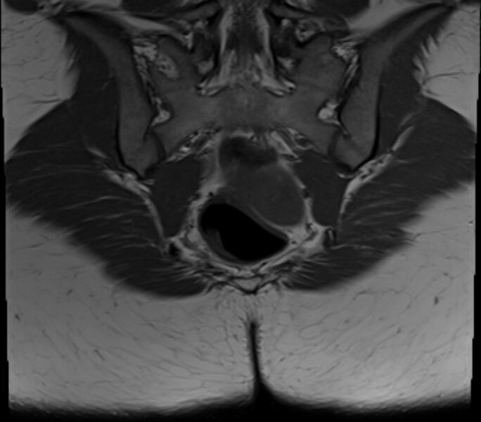 File:Bicornuate uterus (Radiopaedia 71214-81511 Coronal T1 4).jpg