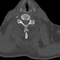 Bilateral C6-7 locked facet dislocation (Radiopaedia 28506-28748 Axial bone window 20).jpeg