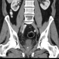 Bilateral direct inguinal herniae (Radiopaedia 17016-16719 A 25).jpg