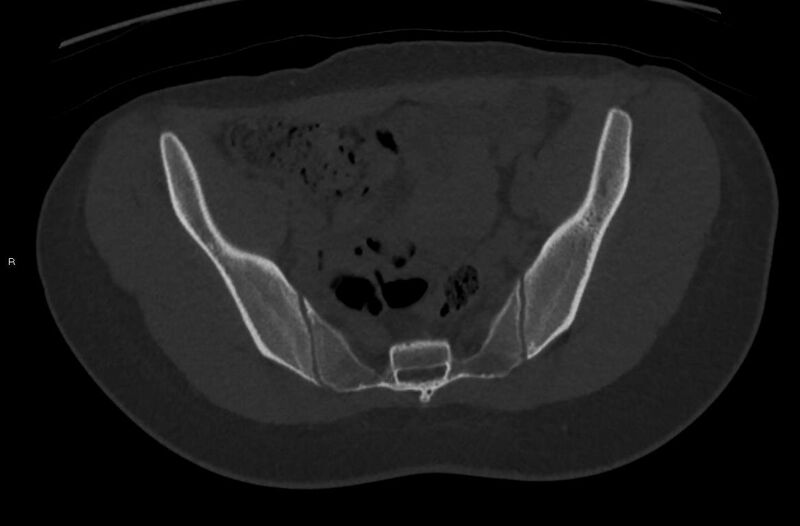 File:Bilateral mature cystic ovarian teratoma (Radiopaedia 88821-105592 Axial bone window 2).jpg