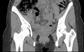 Bilateral mature cystic ovarian teratoma (Radiopaedia 88821-105592 Coronal non-contrast 7).jpg