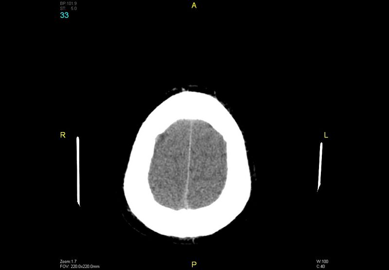 File:Bilateral medial medullary infarction (Radiopaedia 42220-45295 Axial non-contrast 33).jpg