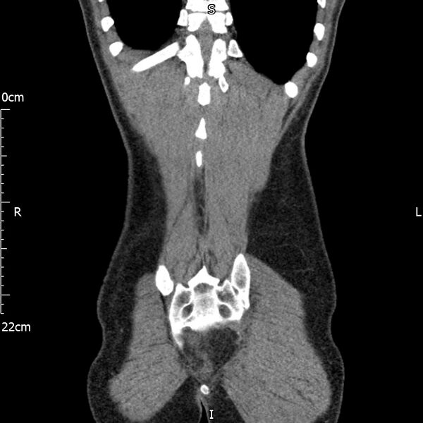 File:Bilateral medullary nephrocalcinosis with ureteric calculi (Radiopaedia 71269-81569 Coronal non-contrast 66).jpg