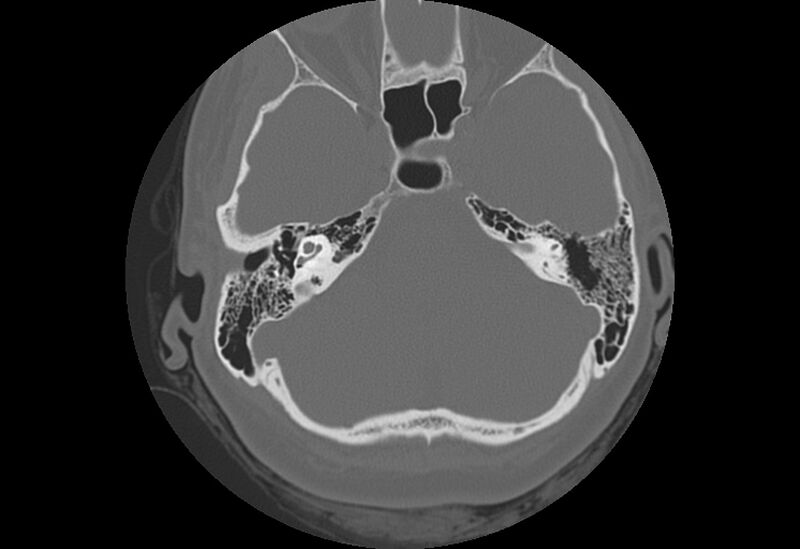 File:Bilateral otospongiosis (Radiopaedia 35447-36940 Axial bone window 31).jpg
