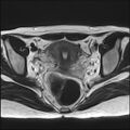 Bilateral ovarian endometriomas (Radiopaedia 87085-103347 Axial T2 12).jpg