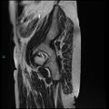 Bilateral ovarian fibroma (Radiopaedia 44568-48293 Sagittal T2 33).jpg