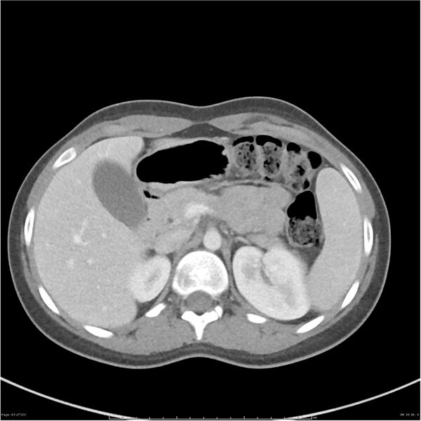 File:Bilateral ureteritis and cystitis (Radiopaedia 25340-25594 A 20).jpg