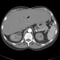 Biliary necrosis - liver transplant (Radiopaedia 21876-21845 A 16).jpg